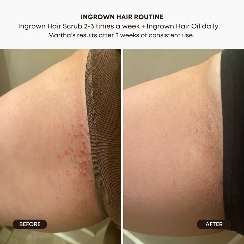 Exfoliant pour Poils Incarnés Watermelon sugar